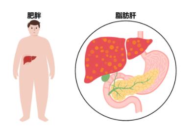 什么是脂肪肝，早期有哪些症状？